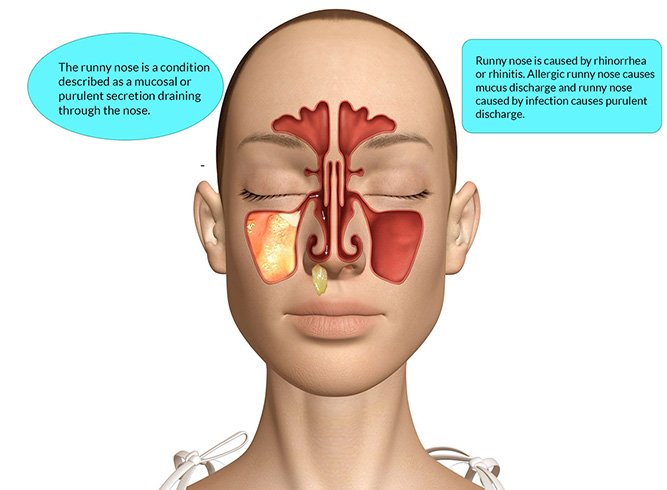 How To Stop Runny Nose - Love For Healthy Food