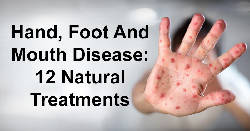 Hand, Foot And Mouth Disease: 12 Natural Treatments - Love For Healthy Food